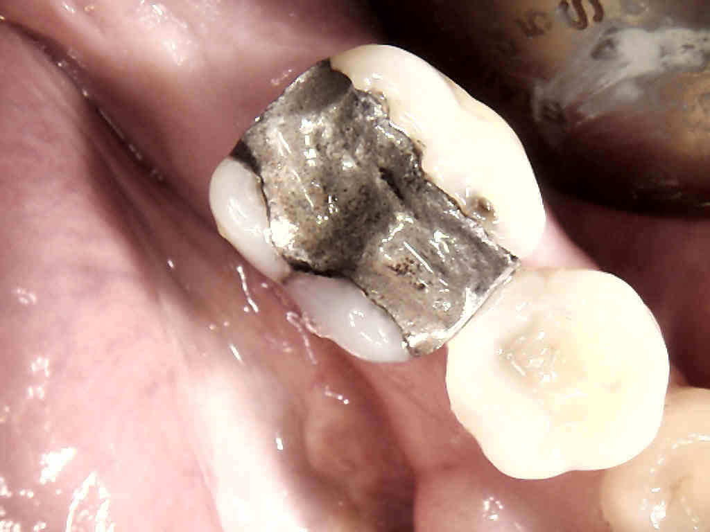 MI20amalgam20with20cracked20tooth201