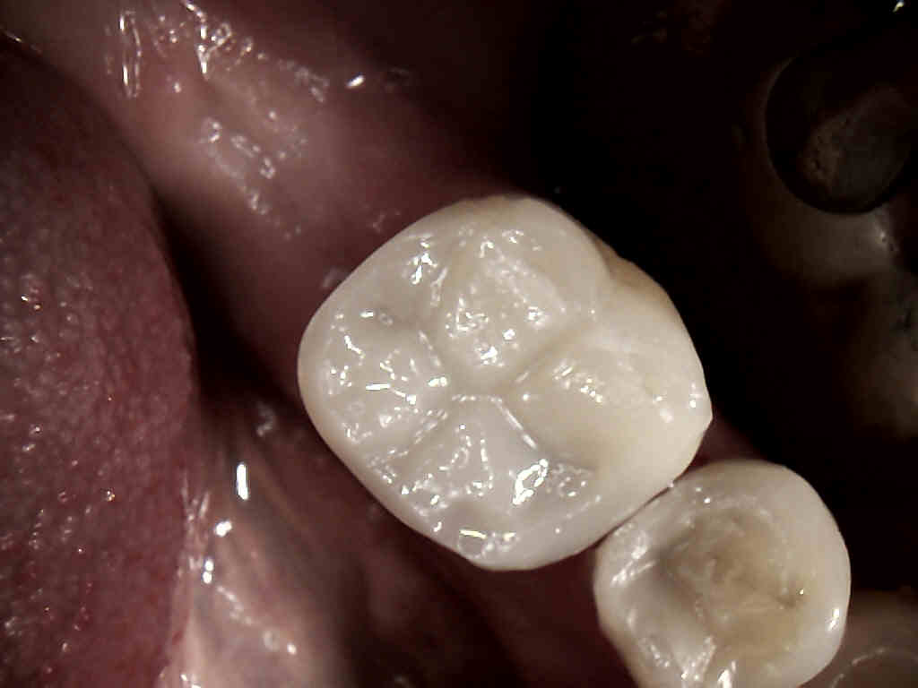 MI20amalgam20with20cracked20tooth202