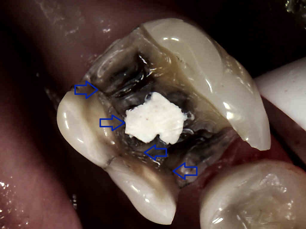 MI20amalgam20with20cracked20tooth20520arrows